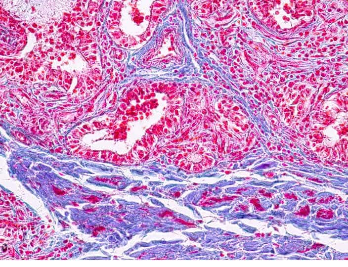 Stained pathology sample.